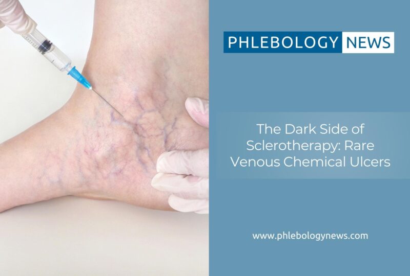 The Dark Side Of Sclerotherapy: Rare Venous Chemical Ulcers 