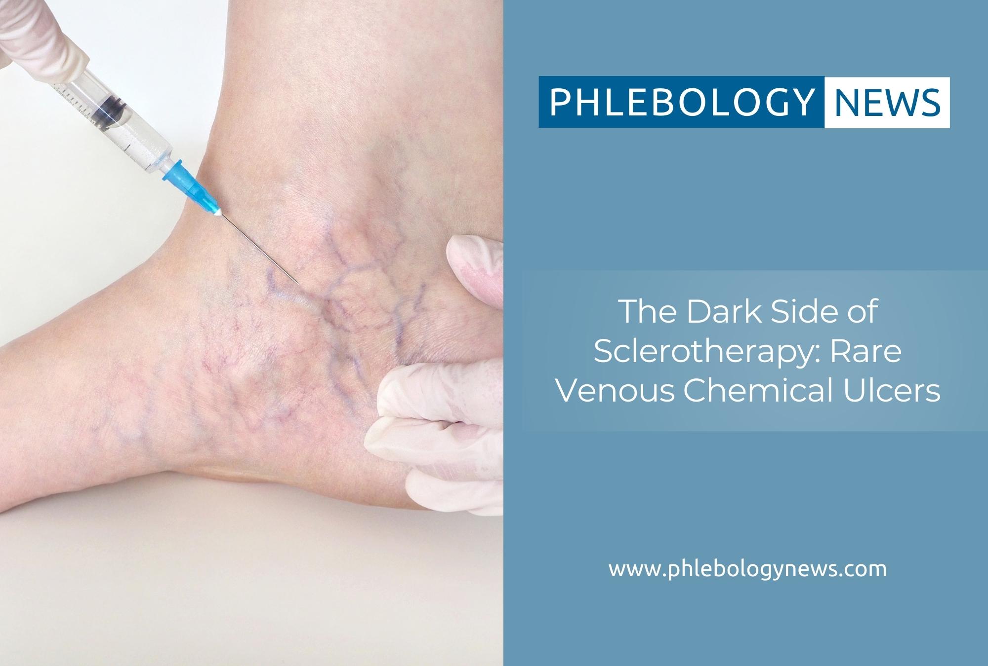 The Dark Side of Sclerotherapy: Rare Venous Chemical Ulcers ...