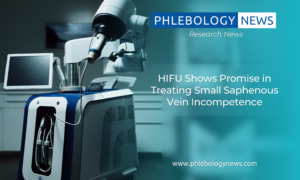 Phlebology News: HIFU Shows Promise in Treating Small Saphenous Vein Incompetence