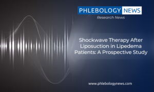 Phlebology News: Shockwave Therapy After Liposuction in Lipedema Patients: A Prospective Study